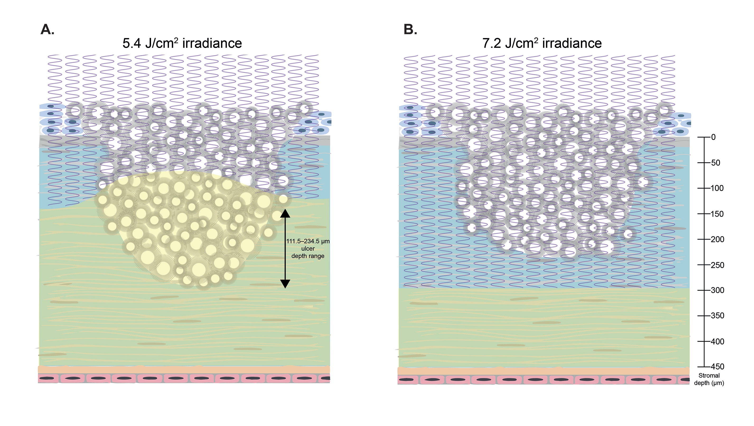 Figure 2: UV fluences greater than 5.4 J/cm² are necessary to treat infectious keratitis with stromal involvement. Riboflavin absorbs UV energy, “shielding” the cornea below, as does the corneal opacity of the ucler. Applying 5.4 J/cm² UV fluence through an opaque ulcer (A) does not kill pathogens deeper than approximately 100 µm, however, applying 7.2 J/cm² (B) does.