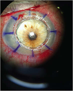 FIGURE 3. Note the appearance of DM after complete corneal stroma removal. IMAGE COURTESY W. BARRY LEE, MD, FACS