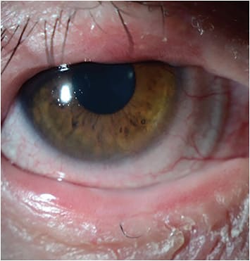 FIGURE 2: Scleral lenses offer the relief of symptoms and support of the ocular surface in SJS.