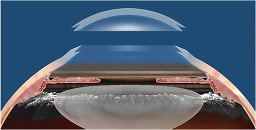 Illustration of zig-zag FLEK.