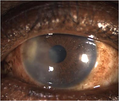 FIGURE 1: Note this interstitial keratitis due to HSV. IMAGE COURTESY HELEN K. WU, MD
