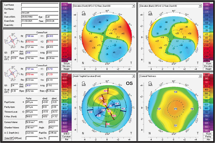 FIGURE 2: Tomography OS, demonstrating longstanding KCN. IMAGE COURTESY KATHRYN HATCH, MD