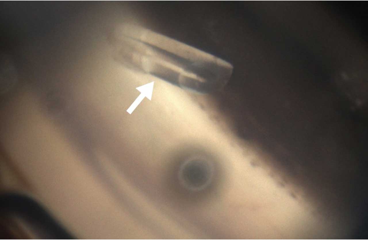 <p><strong>Figure 9. </strong>Postoperative high-resolution image of a Baerveldt tube shunt captured by the NIDEK GS-1 semiautomated gonioscopic imaging system.</p>
