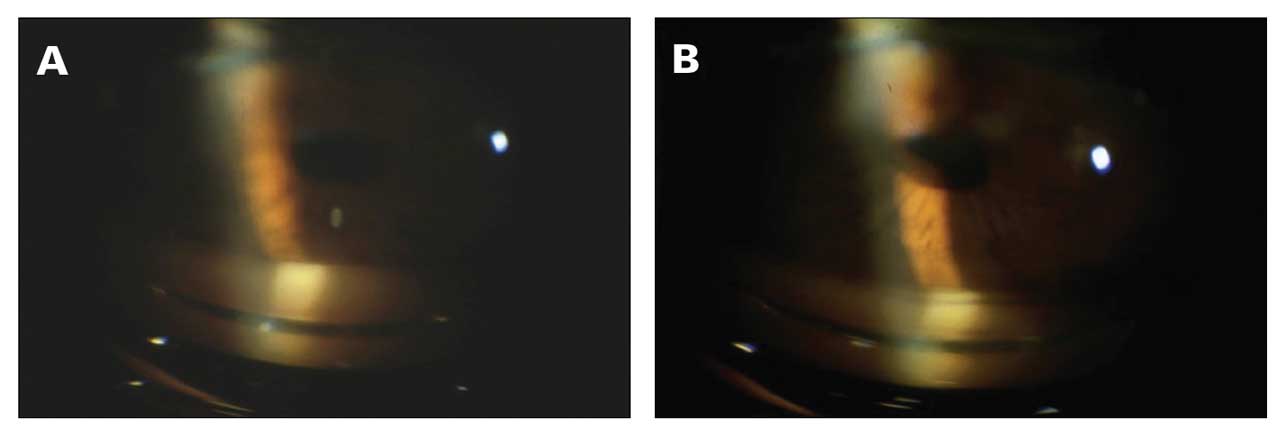 <p><strong>Figure 5. </strong>In this patient undergoing selective laser trabeculoplasty, the narrow angle (A) obscures landmarks and makes visualization difficult. Instructing the patient to look in the direction of the gonioscope mirror (inferiorly in this case) opens the view (B) to the superior angle, clearly revealing the trabecular meshwork and scleral spur.</p>