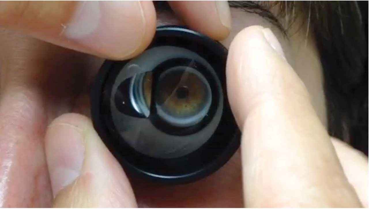 <p><strong>Figure 3. </strong>Proper placement of a 1-mirror laser trabeculoplasty gonioscopy lens. The lens should be rotated through 360&amp;deg; during laser application.</p>