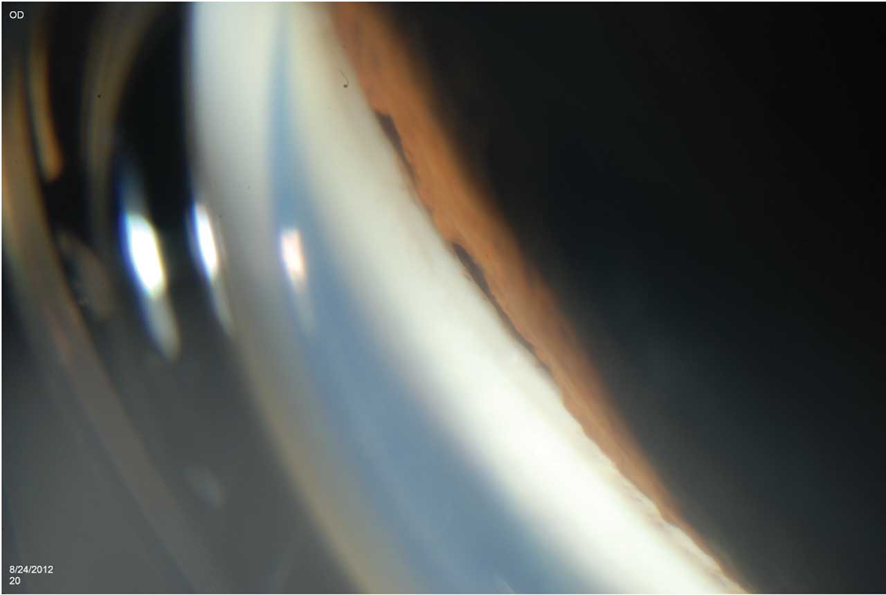 <p><strong>Figure 1. </strong>Four-mirror gonioscopy photograph showing iridodialysis following blunt ocular trauma. Iridodialysis can generally be distinguished from cyclodialysis on gonioscopy by the color of the cleft space: in iridodialysis, the space is usually pigmented due to residual iris tissue, whereas in cyclodialysis it appears white, reflecting exposed sclera after the uveal tissue has detached.</p>