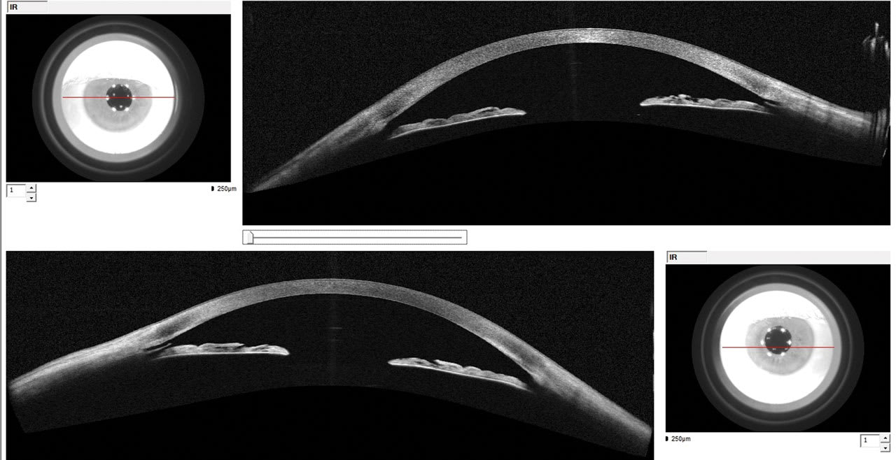 <p><strong>Figure 2.</strong> Angle-to-angle anterior-segment optical coherence tomography imaging shows an open angle. Goniotomy with Kahook Dual Blade created an opening to Schlemm&amp;rsquo;s canal.<span class="Apple-converted-space">&amp;nbsp;</span></p>