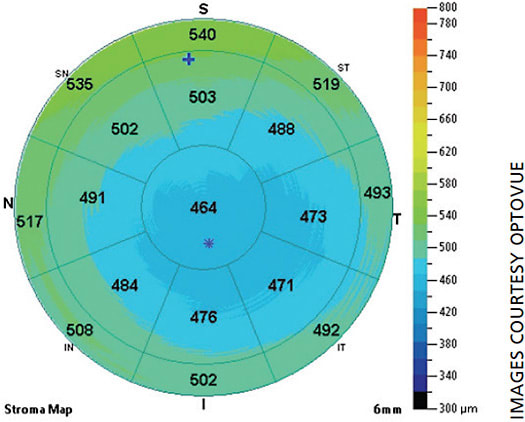 Figure 4. Dry eye disease has a thinning effect on the stroma as well.