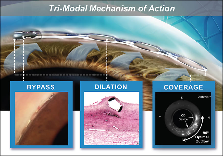 Figure 1. The Hydrus bypasses the trabecular meshwork while also dilating and scaffolding the entire nasal quadrant of  Schlemm’s canal.