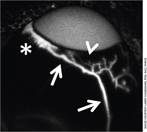 Figure 7. A large outflow vessel revealed by outflow angiography in a cadaveric outflow model.