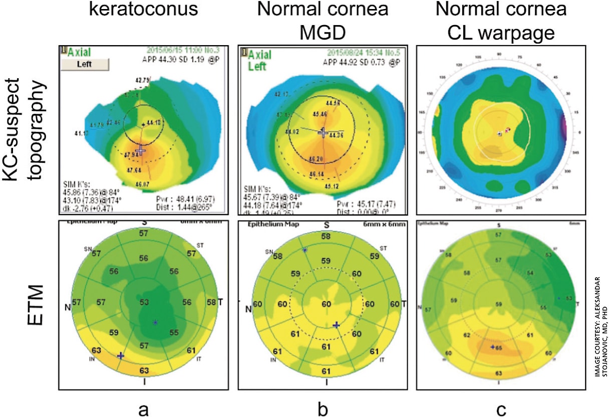 Figure 3. Epithelial thickness mapping for differential diagnosis for candidacy in laser vision correction. Upper row shows anterior axial Placido topographies in three candidates for laser vision correction. Lower row shows epithelial thickness maps measured by Optovue RT-100 (6-mm diameter) showing: a. keratoconus pattern; b. anterior basement membrane dystrophy; c. epithelial warpage due to contact lens use.