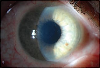 Figure 3A. Somewhat faint areas of central epithelial basement membrane dystrophy can be seen with a wide slit beam from the side.