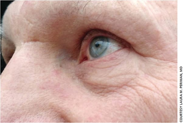 Figure 2. In this photo, the patient’s papulopustular rosacea and ocular rosacea is dramatically improved one week after the third IPL treatment.