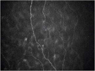 Figure 1. Confocal scan demonstrating corneal nerves in an individual with dry eye symptoms