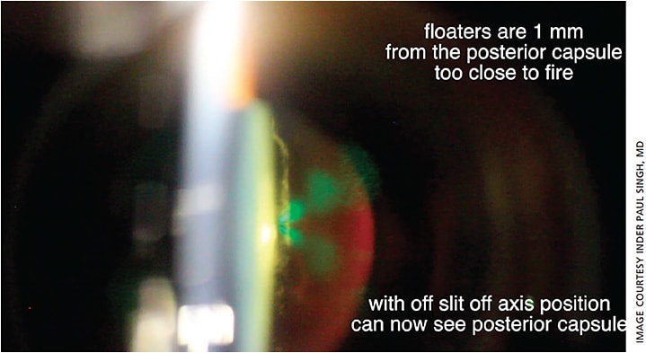 Figure 7. The laser slit lamp is in a slightly oblique (off axis) position, thus decreasing the glare and allowing for visualization of the posterior capsule and the floater. In this case, the floater is too close to the posterior capsule and one would not want to fire.