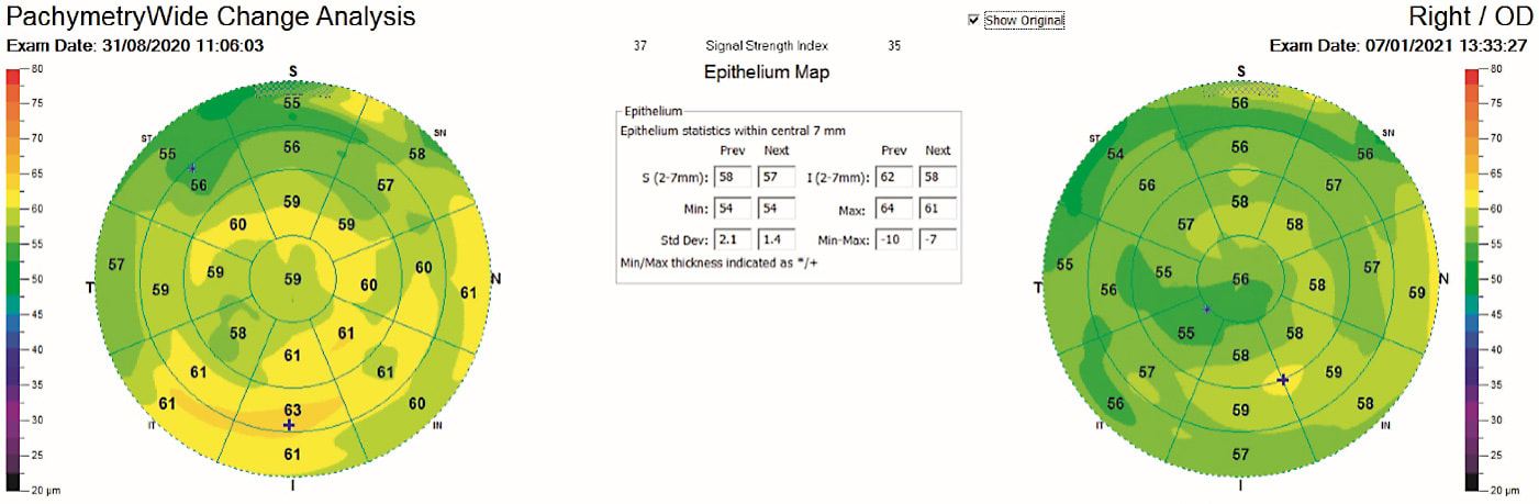 Figure 5. Epithelial thickness maping (ETM) for follow-up after corneal cross-linking (CXL) for keratoconus. Avanti SD-OCT (Optovue) ETM before CXL (left) and 4 months postoperatively (right) show regularization and the desired effect after the treatment.