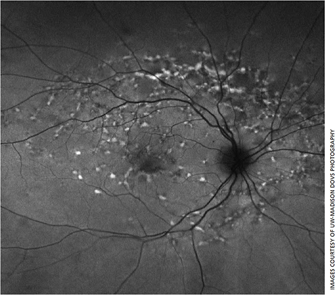 Figure 2. Fundus autofluorescence image corresponding to color image from Figure 1 showing flecks within the macula with both increased and decreased autofluorescence.