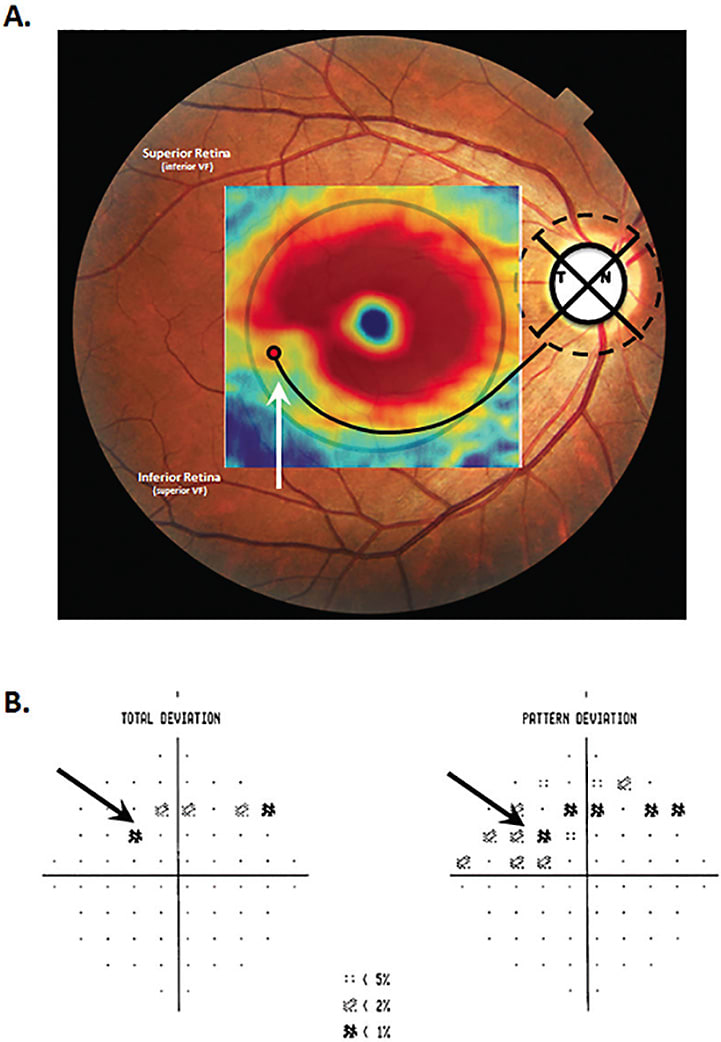 Figure 2. A. A pseudo-color map of the RGC+ thickness as in Figure 1, but for an individual with an arcuate defect close to fixation. B. The total deviation and pattern deviation probability plots for this eye’s 10-2 visual field test. The arrows in both panels indicate corresponding locations.
