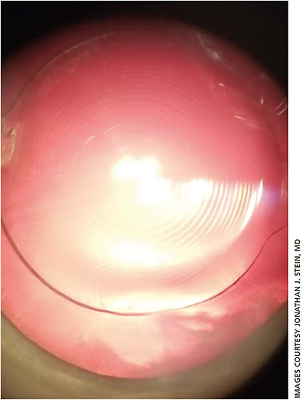 Figure 3. Another view of the multifocal IOL.