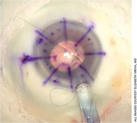 Figure 2. This figure demonstrates a short main corneal incision with a pre-placed 10-0 nylon suture. Notice the DMEK graft within the modified Jones tube is a carpet roll. Maintaining graft orientation during insertion is guided by visualizing the S stamp or upward facing scroll.