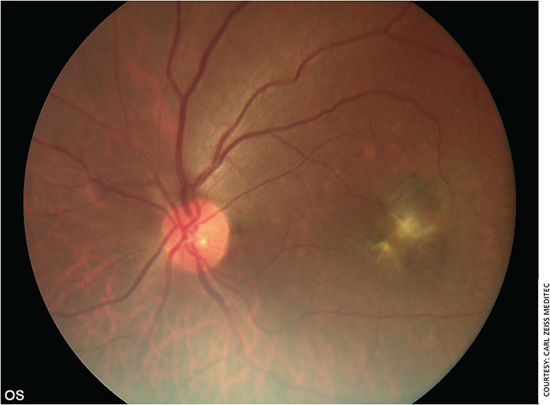 Figure 2. Diabetic retinopathy-affected fundus image of the left eye, taken by VISUSCOUT 100.