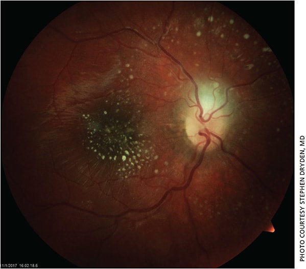 Figure 5. Fundus photo OD showing resolved optic nerve head edema with residual macular exudates.