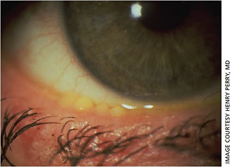 Figure 2. Meibofilm exuding from a patient’s glands.