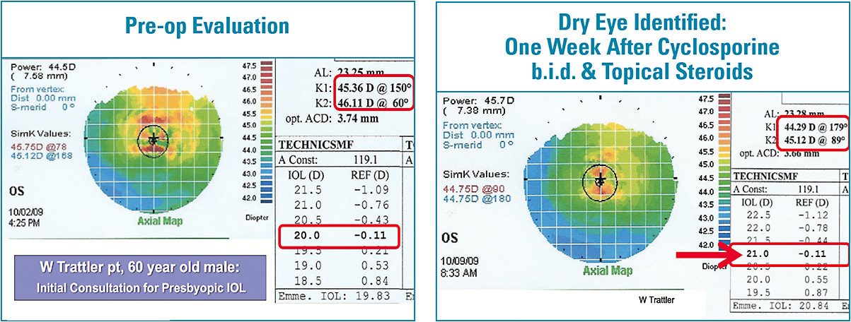 Figure 2. (Left) In a case presented by William Trattler, MD, a 20D IOL power was predicted based on measurements during the initial consultation for a presbyopia-correcting implant; (right) with treatment of dry eye, the ocular surface was optimized, enabling accurate keratometry readings that led to calculation of the true IOL power, 21D.
