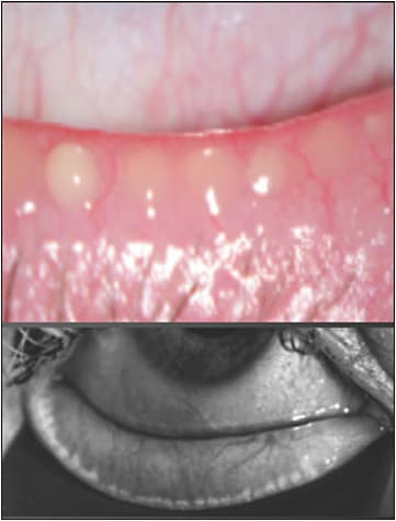 Figure 2. Long-term use of some topical antiglaucoma medications permanently damages the meibomian glands.