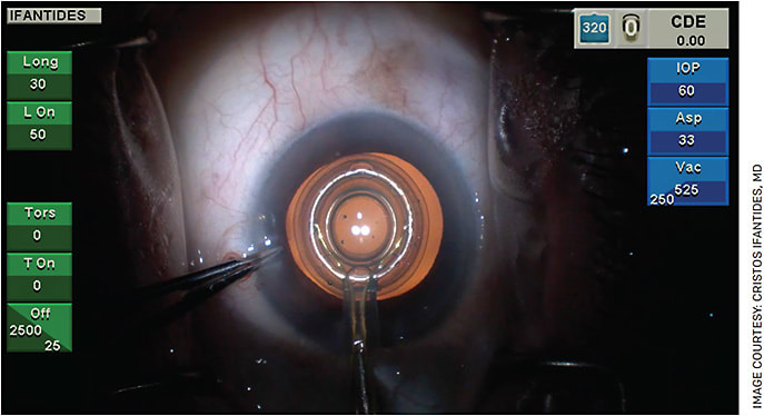 Zepto (Centricity Vision) in action