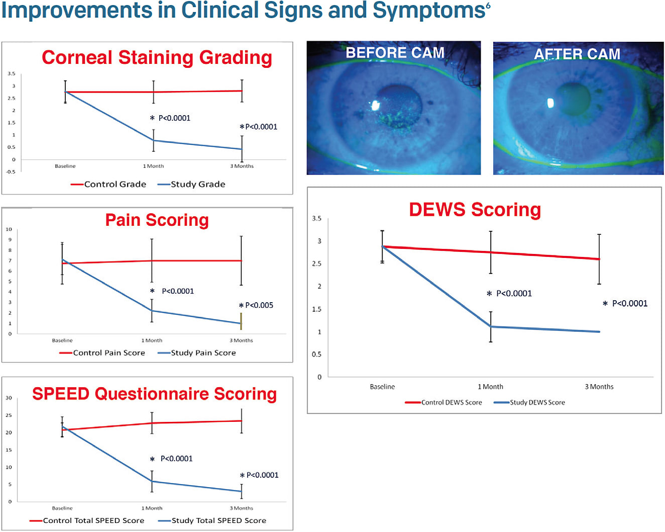 Figure 1. Following treatment with cryopreserved self-retained amniotic membrane (CAM), the corneal surface showed significant improvement.6
