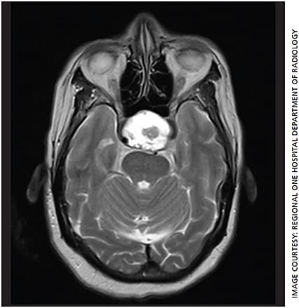 Figure 2. Coronal T1-weighted MRI showing encasement of bilateral internal carotid arteries