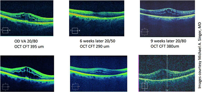 Figure 1: OCT results from the patient, following initial round of anti-VEGF injections.