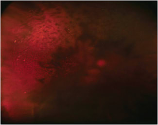 Figure 1. Right eye wide-field fundus photograph.