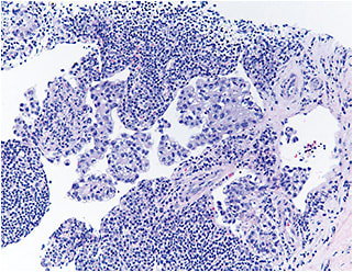 Figure 6. Inguinal node tumor cells stain positively for PAX8 showing tumor cells.