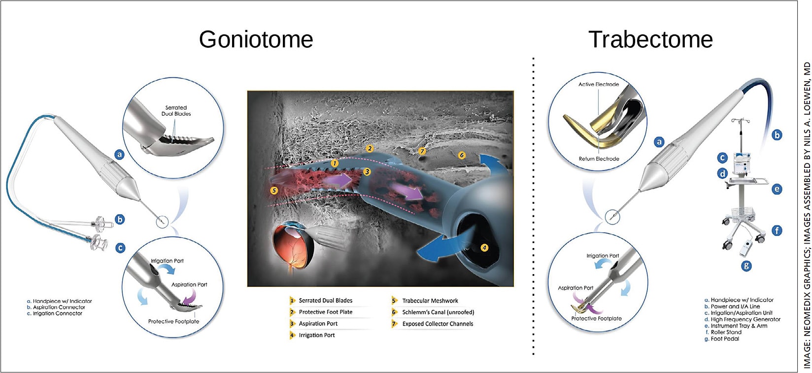 Figure 1. Goniotome and Trabectome. Left: The Goniotome has a serrated dual blade design with irrigation and aspiration ports for active chamber management. Right: The Trabectome with I&amp;A and a high frequency generator for frictionless ablation.
