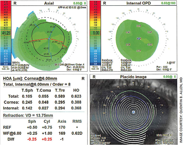 Figure 1. Topography and wavefront aberrometry measurement of the right eye of a 65-year-old white male patient undergoing cataract surgery, with distance targeting and femtosecond CRI.