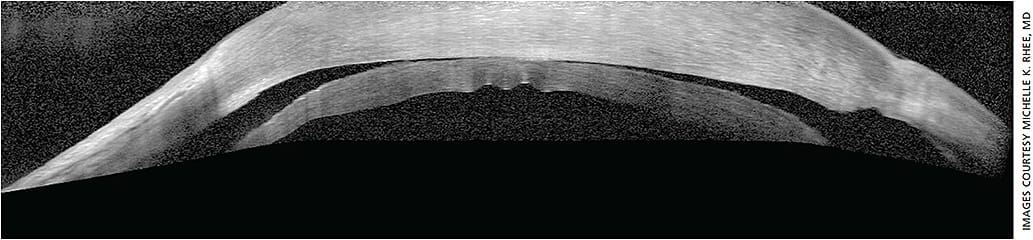 Figure 2. OCT image shows detached DSEK donor tissue.