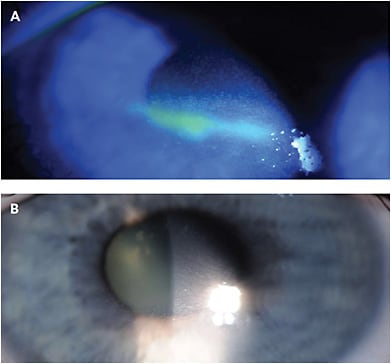 CASE 1: Note this patient’s severe exposure keratopathy before (A) and after amniotic membrane graft (B).