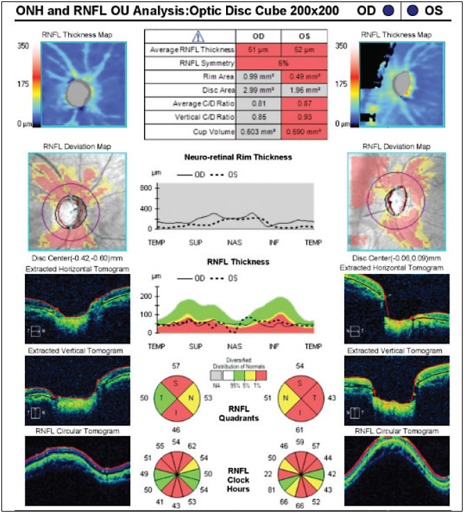 Figure 1. Optical coherence tomography of the patient with steroid-induced glaucoma showing severe thinning of the peripapillary retinal nerve fiber layer as well as optic disc cupping.