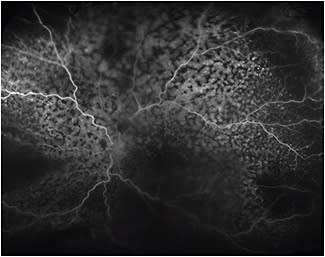 Figure 4. Left eye fluorescein angiogram.