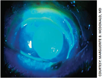 Immediate postop slit-lamp photo of Mrs. Cassady’s eye.
