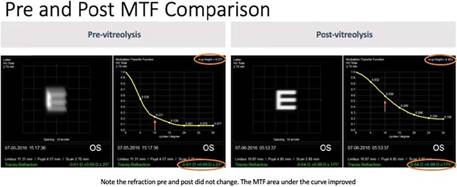 Figure 15. The same LFT patient evaluating MTF curves. MTF area under the curve increased from 0.271 to 0.483. The representative “E” cleared post treatment, and the autorefraction did not change, indicating the only change to the optical system was the removal of the floater from the visual axis.
