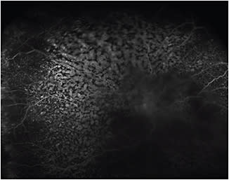 Figure 3. Right eye fluorescein angiogram.