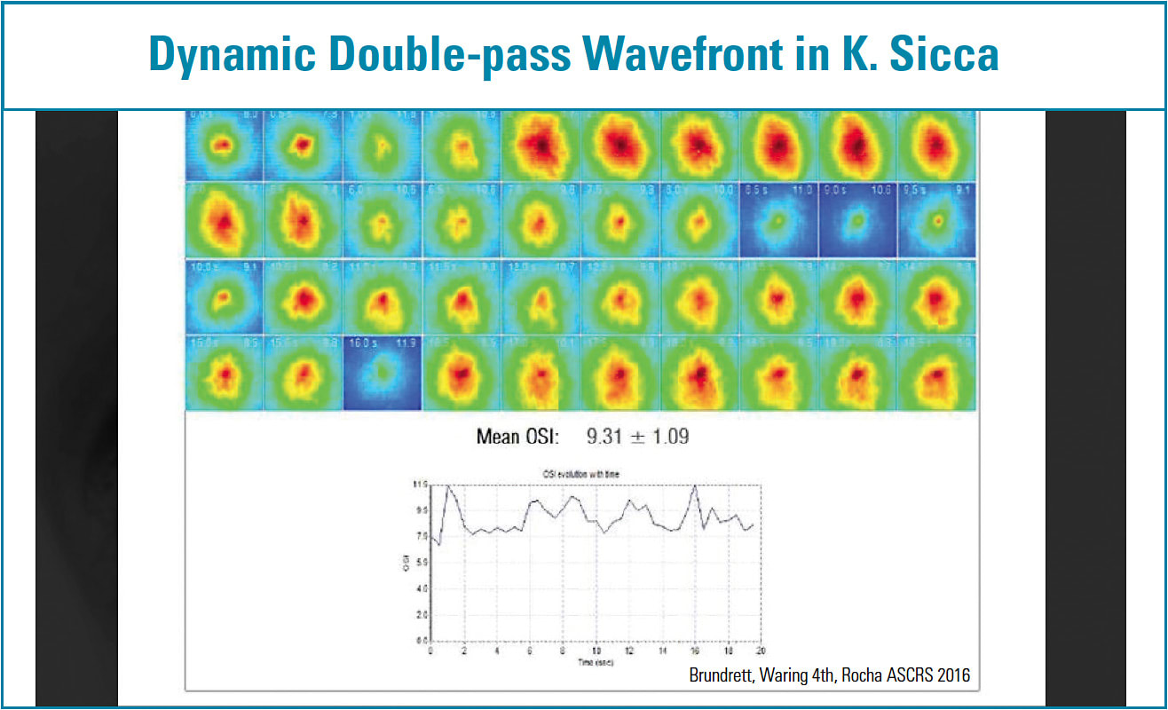 Figure 2. Dynamic double-pass wavefront technology objectively shows how poor tear film quality degrades vision.