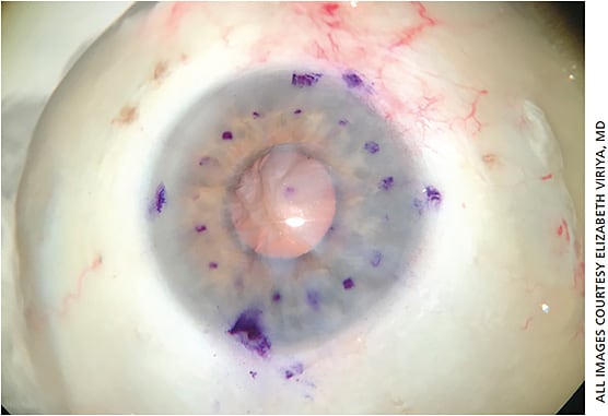 Figure 1. Markings highlight three paracenteses at the limbus. The dotted midperipheral circle is the landmark for descemetorhexis construction and DMEK centration.