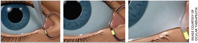 An image of Dextenza being inserted into the eye’s inferior canaliculus. The insert releases a sustained and tapered dose of dexamethasone for up to 30 days after surgery.