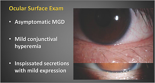 Figure 1. Clinical exam of a patient newly diagnosed with POAG revealed MGD and mild conjunctival hyperemia.