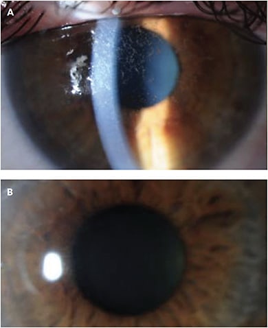 CASE 4. Note this patient’s neurotrophic keratitis (A), and its resolution post amniotic membrane graft (B).