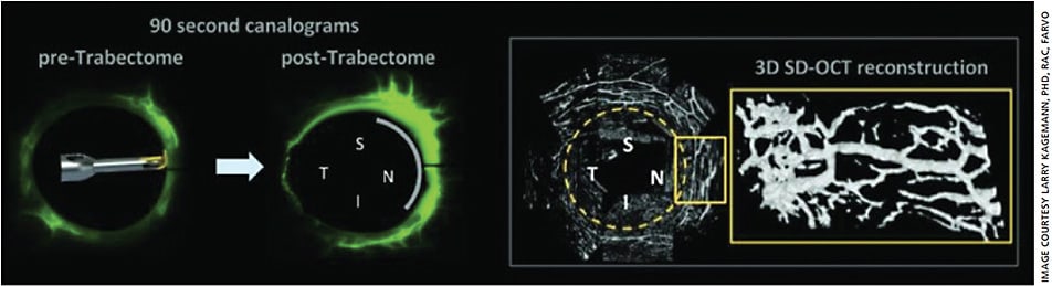 Figure 8. Outflow angiography (left) combined with virtual casting (right) demonstrates the recruitment of previously quiescent outflow vasculature after ab interno trabeculoplasty.